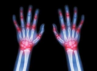 Rheumatoid Arthritis